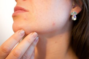 woman holding her chin with acne